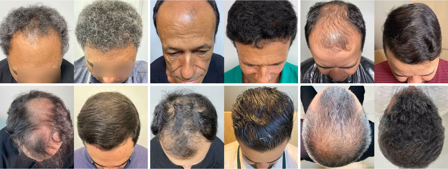 Mosaico de antes e depois de pacientes do Instituto Gustavo Martins